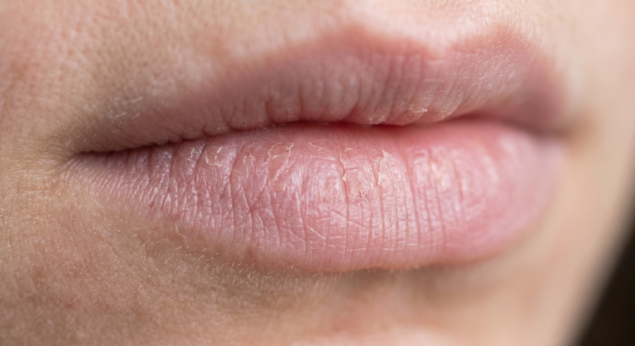 Verzorging voor droge en schrale lippen
