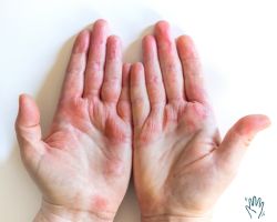 "Close-up van een hand met zichtbare kloofjes en droge huid, vooral rond de knokkels en vingertoppen. De huid toont tekenen van barstjes, roodheid en schilfering, veroorzaakt door uitdroging en externe invloeden zoals kou en reinigingsmiddelen. Ideaal ter illustratie van huidproblemen waarbij intensieve verzorging nodig is. Ambachtscrème is geschikt voor dit type huid en helpt bij het herstel van kloofjes en het behoud van een soepele huidbarrière.